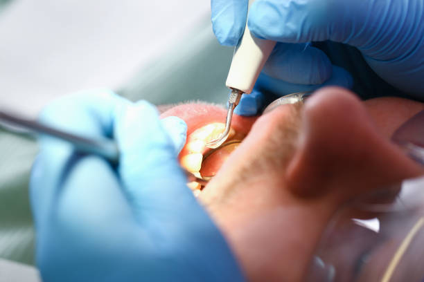 Best Emergency Wisdom Teeth Removal in Robert Lee, TX